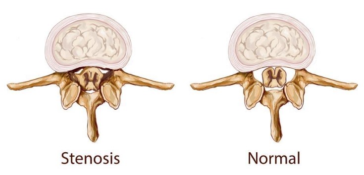 Canal stenosis