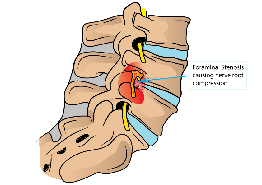 Foraminal stenosis