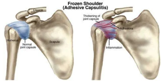Frozen shoulder
