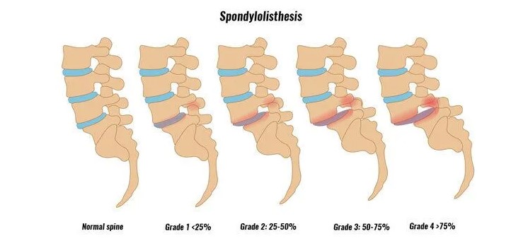Grades of Spondylolisthesis