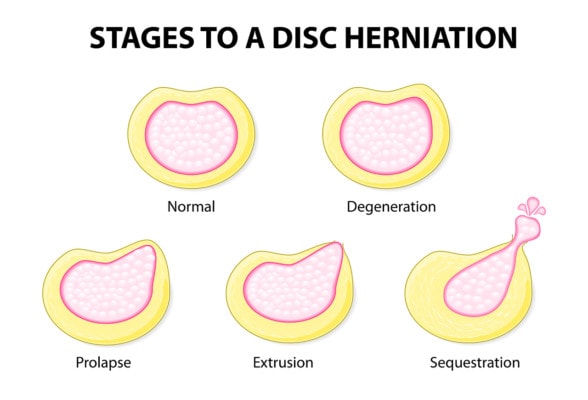Progression of disc bulge