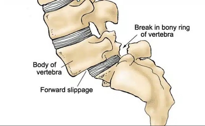 Spondylolisthesis