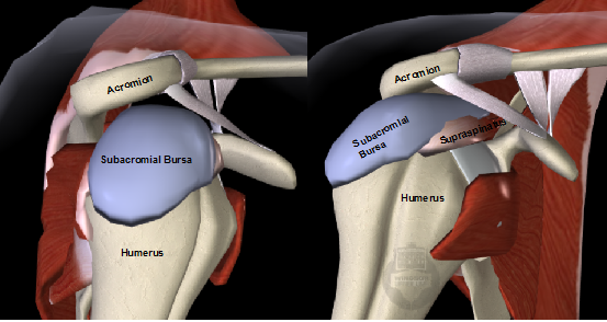 Subacromial bursa impingement