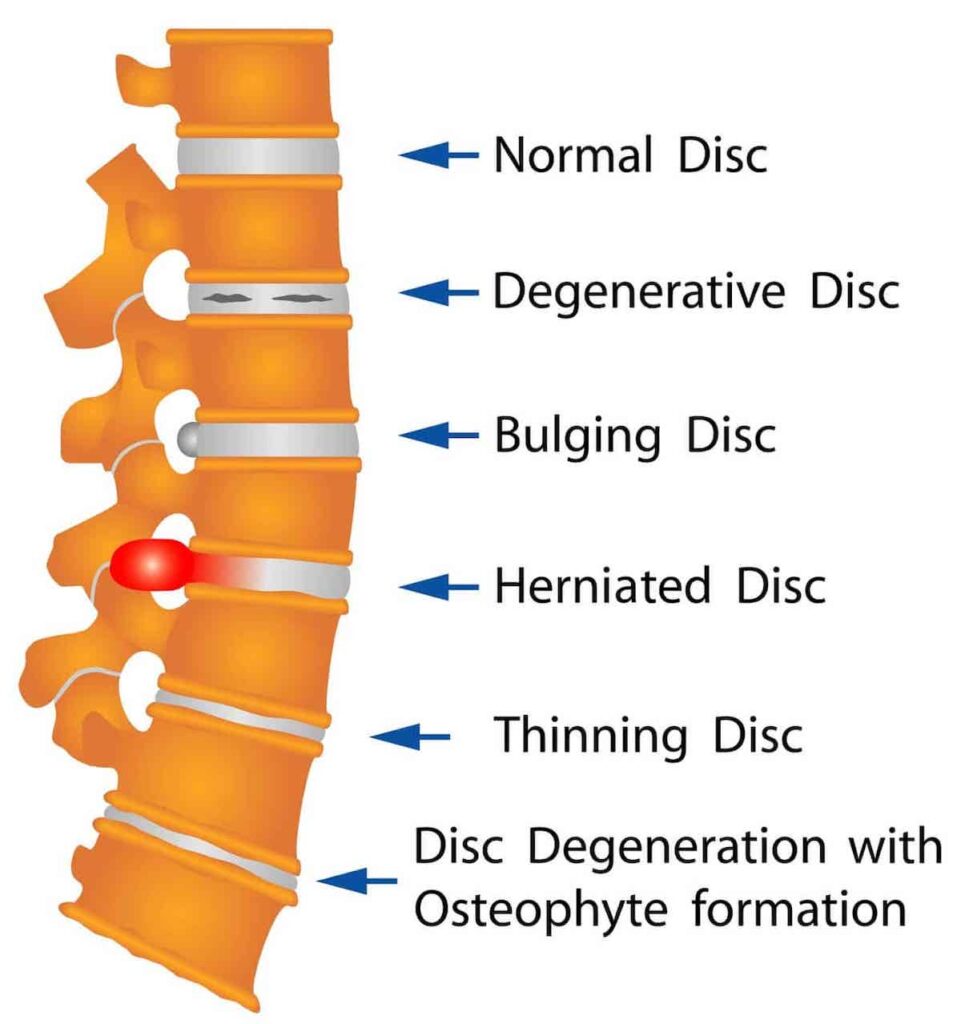 Various types of disc injuries